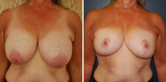 Breast Reduction Before and After Photos in Boston, MA, Patient 3218