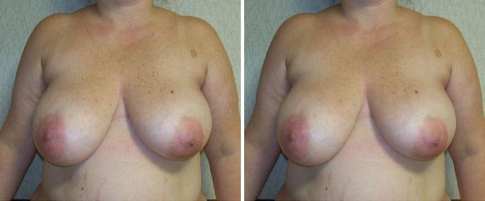 Patient 3222, Breast Reduction before and after photos Breast Reduction before and after photos in Boston, MA, Patient 3222