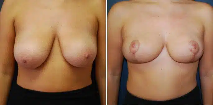 Patient 3214, Breast Reduction Before and After Photos Breast Reduction Before and After Photos in Boston, MA, Patient 3214