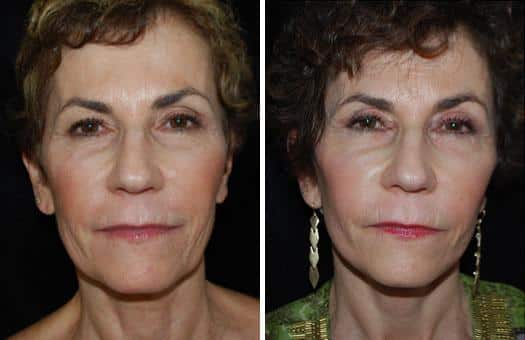 Patient 3227, Facelift Before and After Photos Facelift Before and After Photos in Boston, MA, Patient 3227
