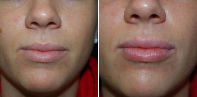 Patient 3231, Lip Augmentation before and after photos Lip Augmentation before and after photos in Boston, MA, Patient 3231