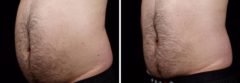 Male SculpSure Before and After Photos in Boston, MA, Patient 3288