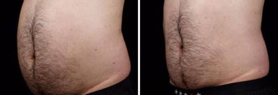 Male SculpSure Before and After Photos in Boston, MA, Patient 3288