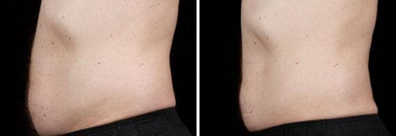 Male SculpSure Before and After Photos in Boston, MA