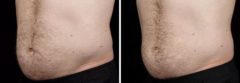 Male SculpSure Before and After Photos in Boston, MA, Patient 3284