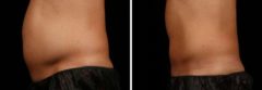 Male SculpSure Before and After Photos in Boston, MA, Patient 3296