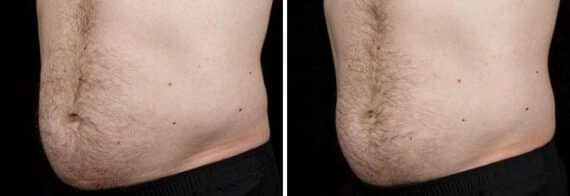 Male SculpSure Before and After Photos in Boston, MA, Patient 3284