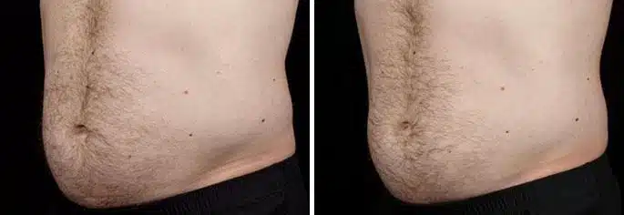 Male SculpSure Before and After Photos in Boston, MA, Patient 3284