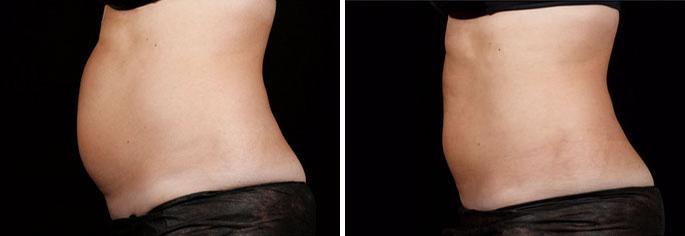 Patient 3275, SculpSure before and after photos SculpSure before and after photos in Boston, MA, Patient 3275