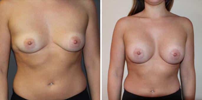 Patient 3268, Breast Augmentation Before and After Photos Breast Augmentation Before and After Photos in Boston, MA, Patient 3268