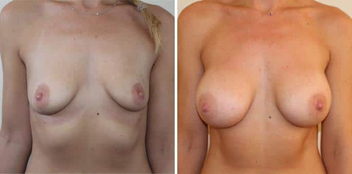 Patient 3187, Breast Augmentation Before and After Photos Breast Augmentation Before and After Photos in Boston, MA, Patient 3187