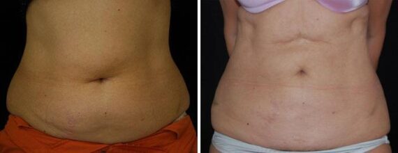 Liposuction Before and After Photos in Boston, MA, Patient 3240