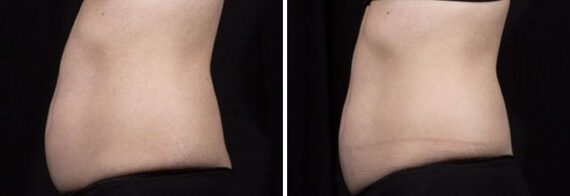 SculpSure Before and After Photos in Boston, MA, Patient 3280