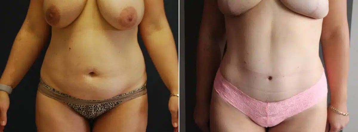 Tummy Tuck Before and After Photos in Boston, MA, Patient 3156