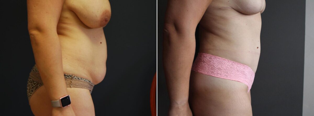 Tummy Tuck Before and After Photos in Boston, MA, Patient 3156