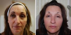 Voluma Before and After Photos in Boston, MA, Patient 3300