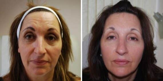 Voluma Before and After Photos in Boston, MA