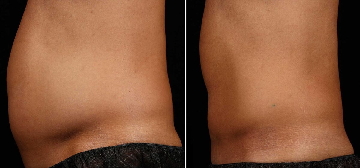 Patient 3367, SculpSure Before and After Photos SculpSure Before and After Photos in Boston, MA, Patient 3367