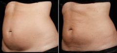 SculpSure Before and After Photos in Boston, MA, Patient 3411