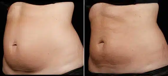 SculpSure Before and After Photos in Boston, MA