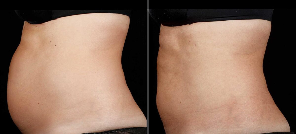 SculpSure Before and After Photos in Boston, MA, Patient 3411