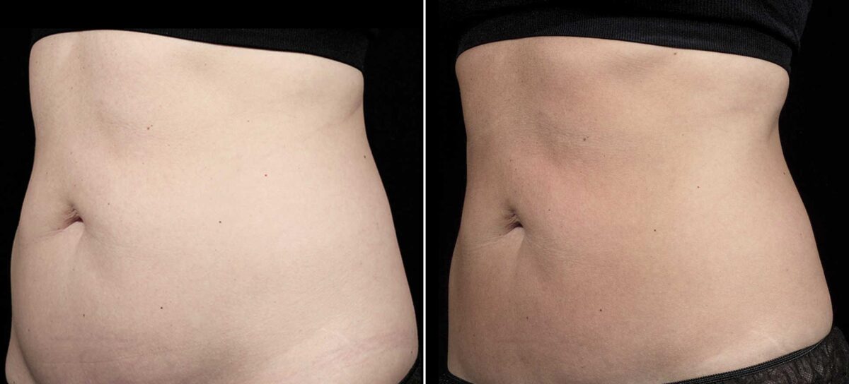 SculpSure Before and After Photos in Boston, MA, Patient 3418