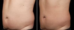 SculpSure Before and After Photos in Boston, MA, Patient 3378