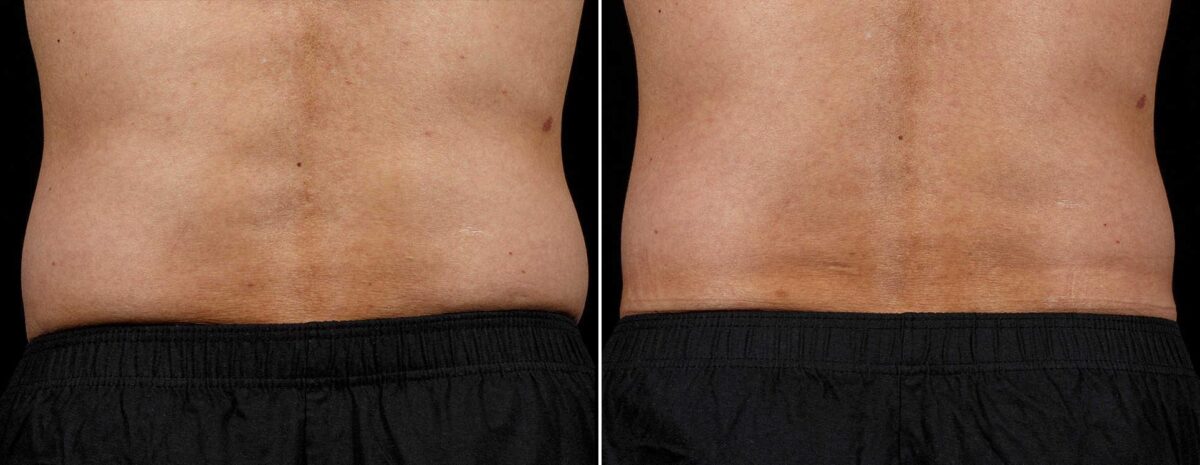 SculpSure Before and After Photos in Boston, MA, Patient 3383