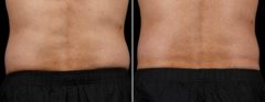 SculpSure Before and After Photos in Boston, MA, Patient 3383