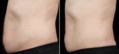 SculpSure Before and After Photos in Boston, MA, Patient 3387