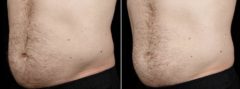 SculpSure Before and After Photos in Boston, MA, Patient 3392