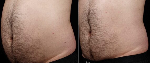 SculpSure Before and After Photos in Boston, MA, Patient 3396