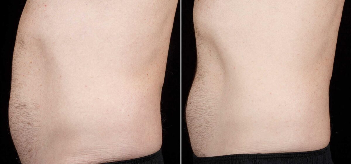 Patient 3403, SculpSure before and after photos SculpSure before and after photos in Boston, MA, Patient 3403