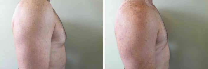 Patient 2533, Gynecomastia before and after photos Gynecomastia before and after photos in Boston, MA, Patient 2533