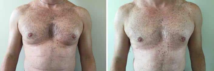 Patient 2533, Gynecomastia before and after photos Gynecomastia before and after photos in Boston, MA, Patient 2533