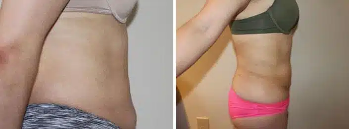 Liposuction Before and After Photos in Boston, MA, Patient 2462