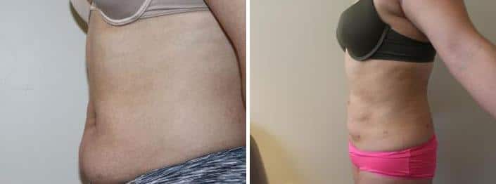 Liposuction Before and After Photos in Boston, MA, Patient 2462