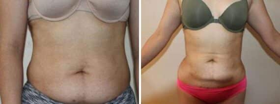 Liposuction Before and After Photos in Boston, MA, Patient 2462