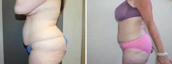 Liposuction Before and After Photos in Boston, MA, Patient 2469