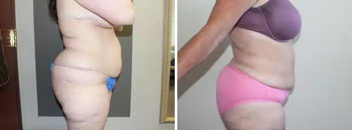 Liposuction Before and After Photos in Boston, MA, Patient 2469