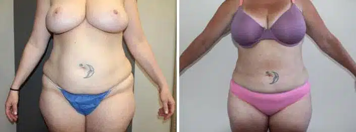 Liposuction Before and After Photos in Boston, MA, Patient 2469