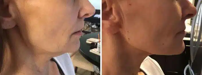 Thread Lift Before and After
