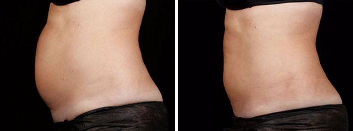 SculpSure Before and After Photos in Boston, MA, Patient 3275