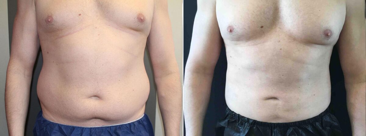 Patient 3351, Male Liposuction Before and After Photos Male Liposuction Before and After Photos in Boston, MA, Patient 3351