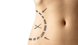 Liposuction | Boston, MA