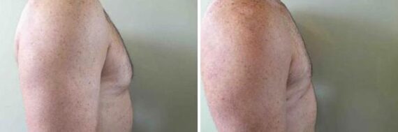 Gynecomastia Before and After Photos in Boston, MA, Patient 2533