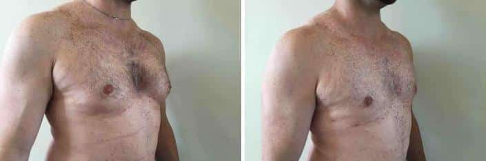 Gynecomastia Before and After Photos in Boston, MA, Patient 2533