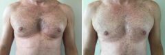 Gynecomastia Before and After Photos in Boston, MA, Patient 2533