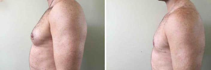 Gynecomastia Before and After Photos in Boston, MA, Patient 2533