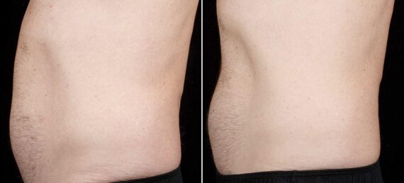 SculpSure Before and After Photos in Boston, MA, Patient 3403